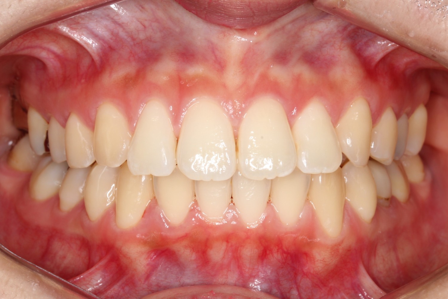 上顎前歯の突出　凸凹　インビザライン　マウスピース矯正