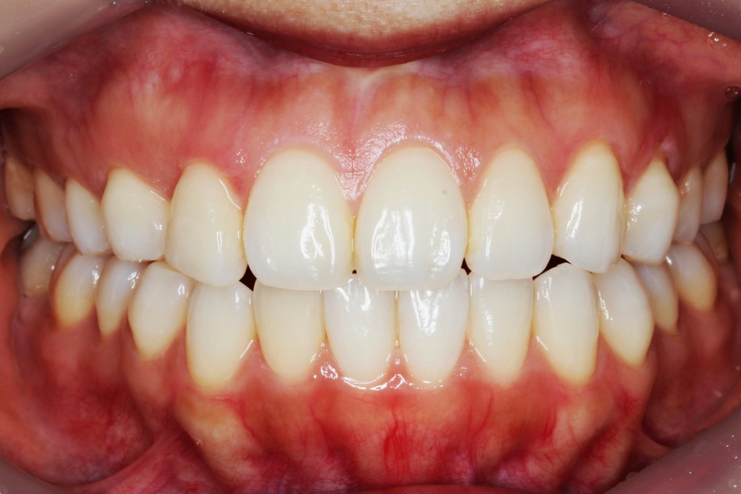 上下前歯の凸凹 インビザライン マウスピース矯正