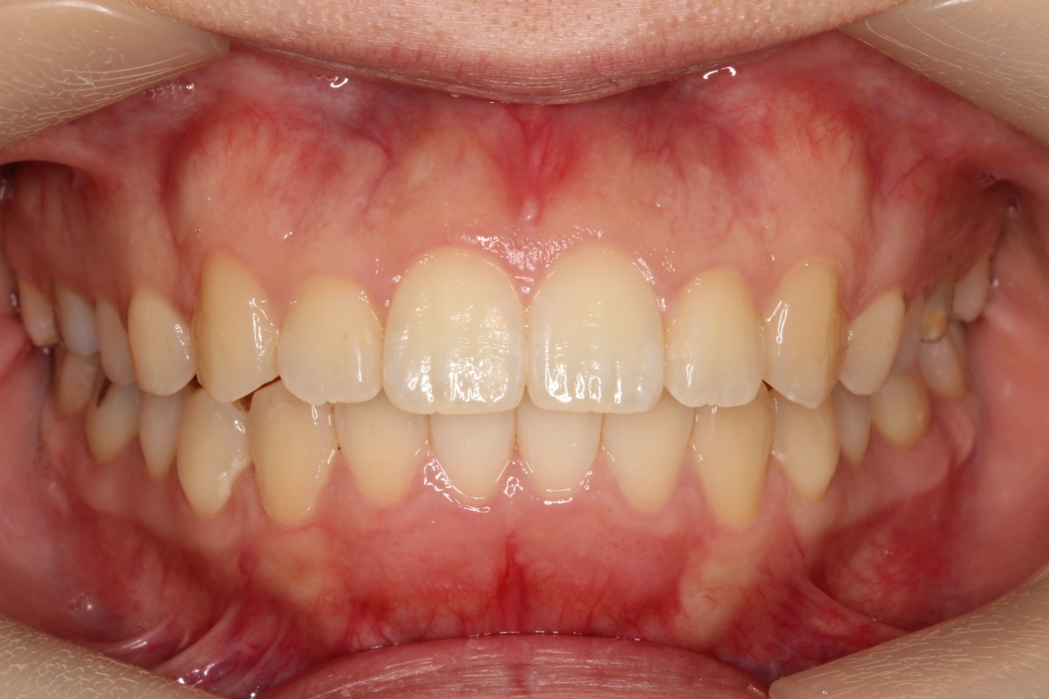 前歯の凸凹 八重歯 マウスピース矯正 インビザライン