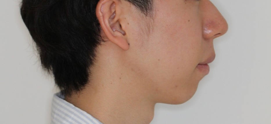 上下前歯の凸凹　出っ歯　裏側矯正