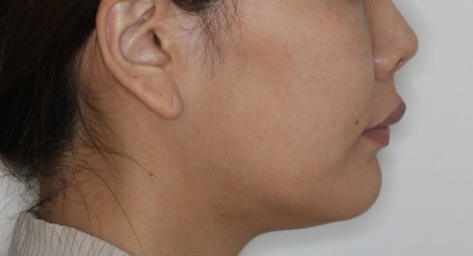 上の前歯が出ている　口元を下げたい