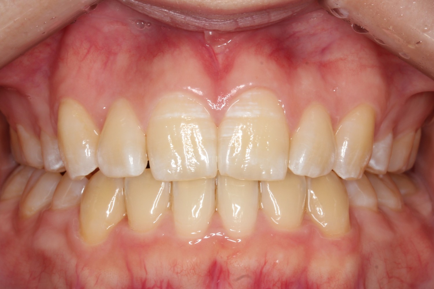 前歯凸凹 八重歯 裏側矯正 リンガル矯正