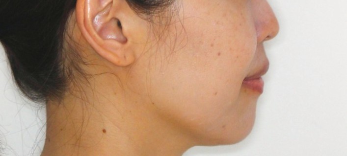 上下の凸凹　口元下げたい　リンガル矯正　マウスピース矯正