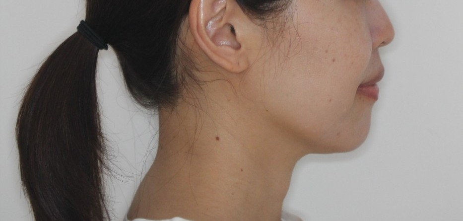 上下の凸凹　口元下げたい　リンガル矯正　マウスピース矯正