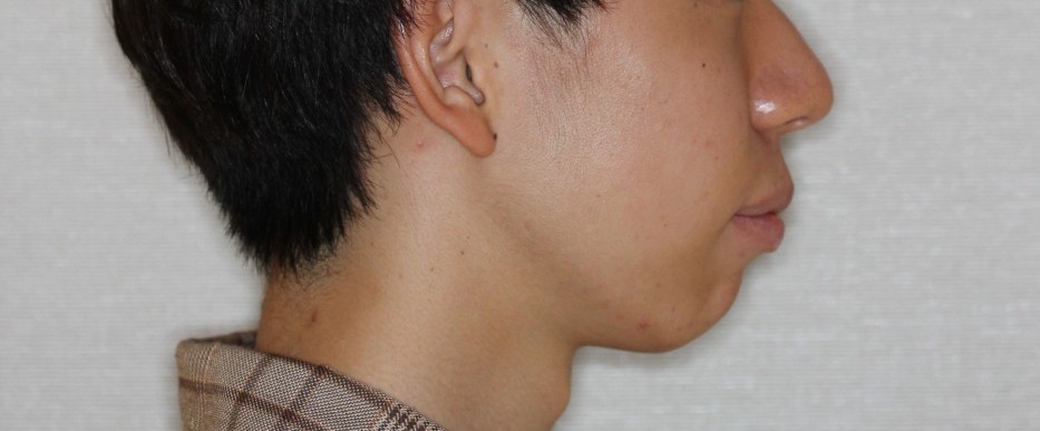 上下前歯の凸凹　出っ歯　裏側矯正