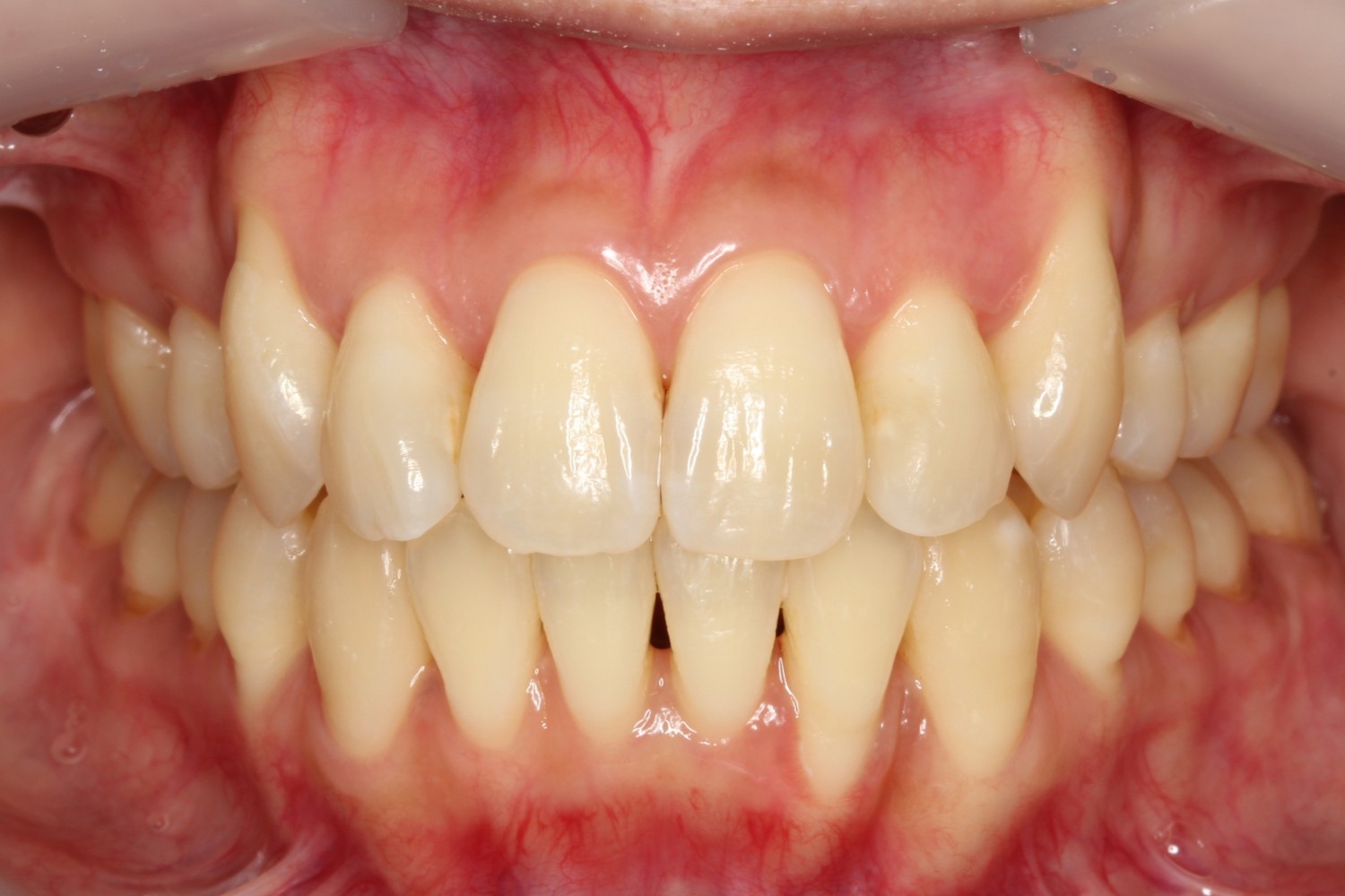 上下前歯凸凹　噛み合わせが悪い　ハーフリンガル矯正
