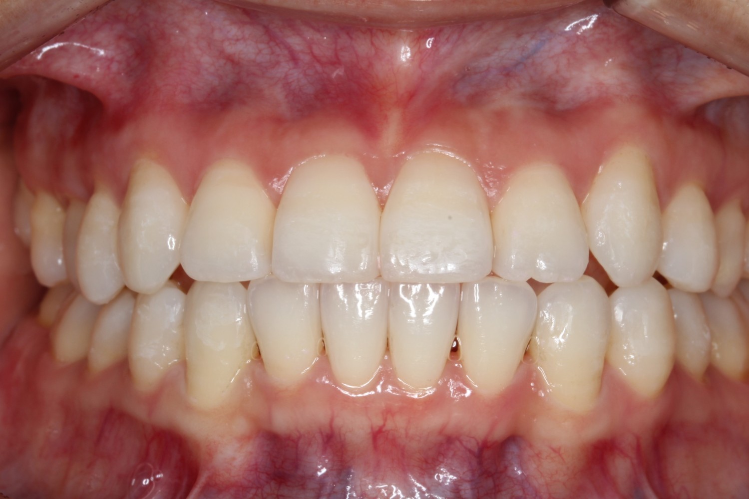 上下前歯の凸凹 インビザライン マウスピース矯正