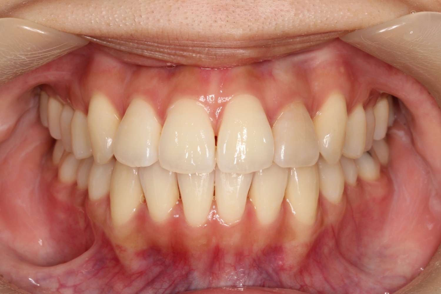 上下前歯の凸凹　インビザライン　マウスピース矯正