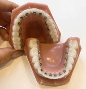 歯列不正　むし歯　虫歯　歯周病