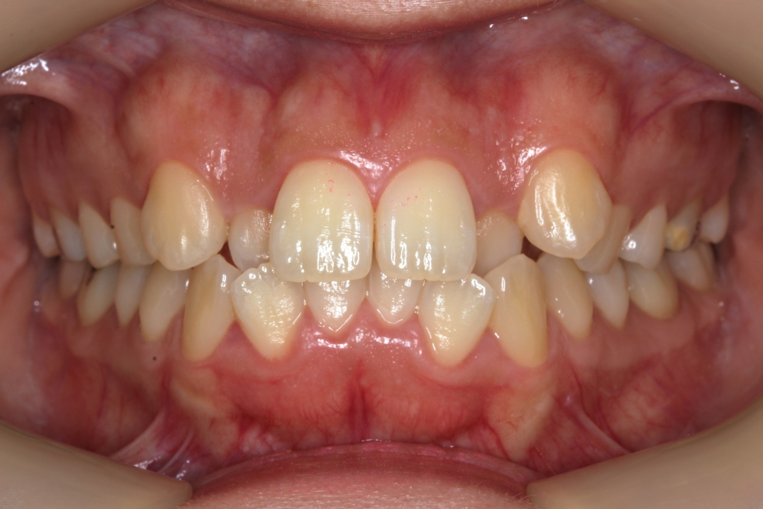 前歯の凸凹 八重歯 マウスピース矯正 インビザライン
