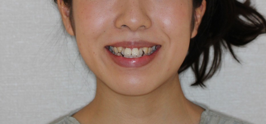 八重歯　前歯の凸凹　インビザライン　マウスピース矯正