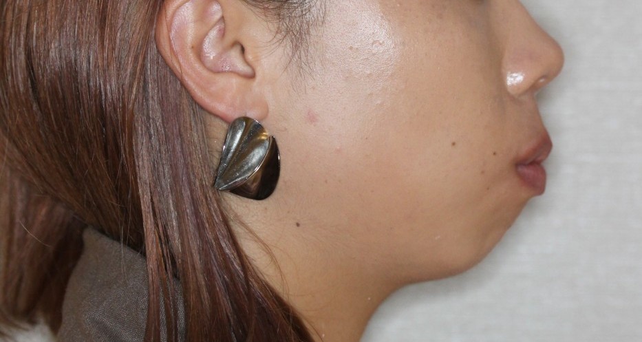 口元を下げたい　リンガル矯正