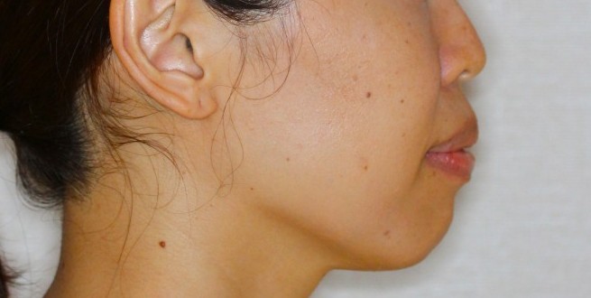 上下の凸凹　口元下げたい　リンガル矯正　マウスピース矯正