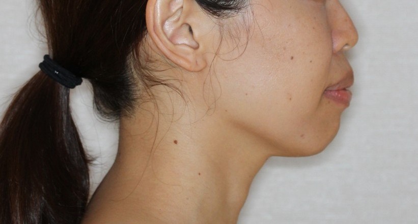 上下の凸凹　口元下げたい　リンガル矯正　マウスピース矯正