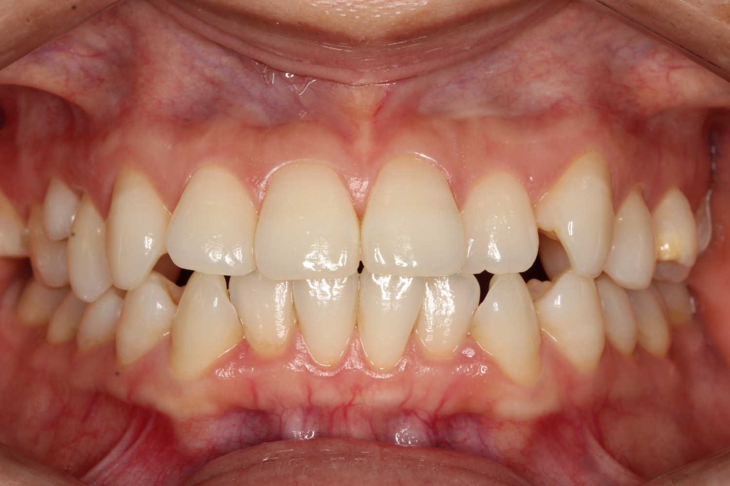 上下前歯の凸凹 インビザライン マウスピース矯正