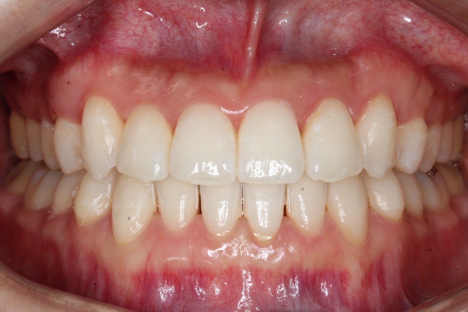 上下の凸凹　噛み合わせが悪い　マウスピース矯正　インビザライン