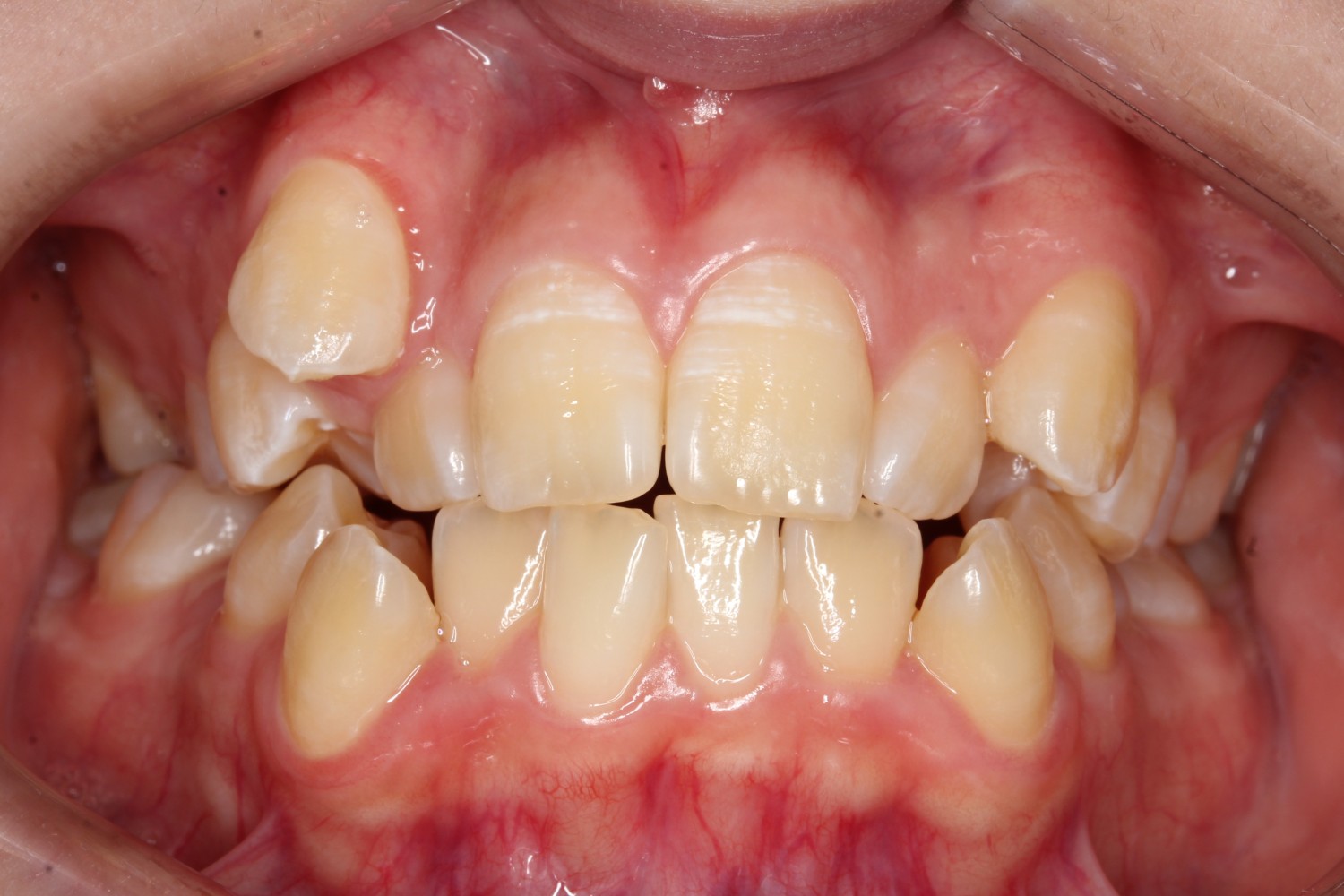 前歯凸凹 八重歯 裏側矯正 リンガル矯正