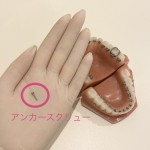 矯正用アンカースクリュー　いつまで　痛み