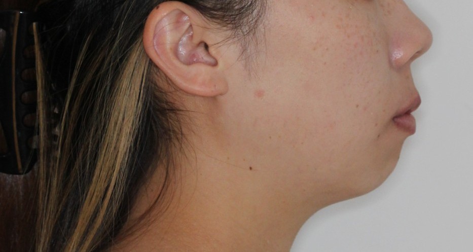 口元を下げたい　リンガル矯正