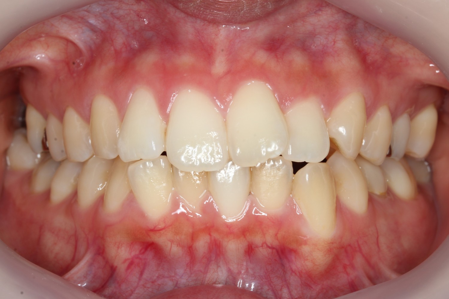 上顎前歯の突出　凸凹　インビザライン　マウスピース矯正