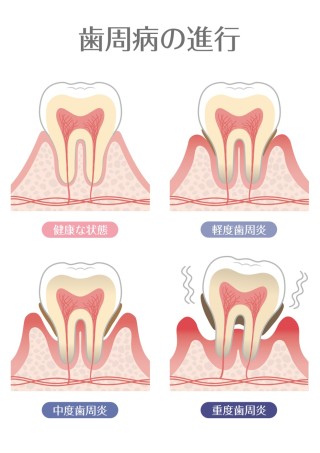 歯周病　歯が抜ける　噛み合わせ