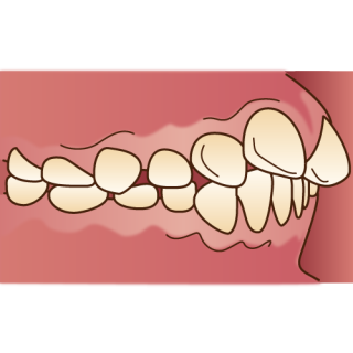 噛み合わせ　出っ歯　健康寿命