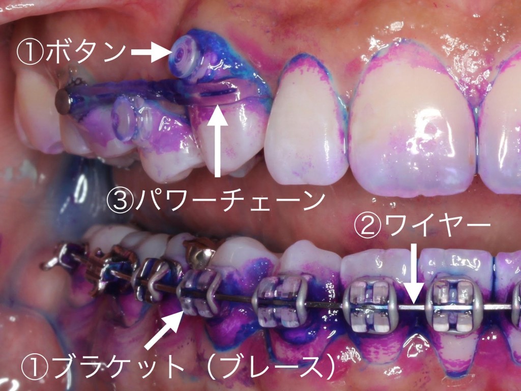 裏側矯正　表側矯正　虫歯予防