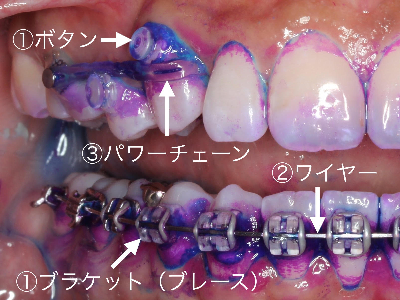 裏側矯正 表側矯正 虫歯予防