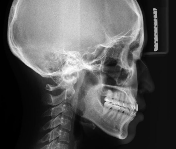 セファロ分析　矯正治療　精密検査　