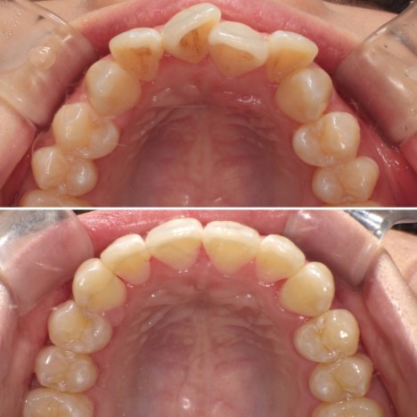 歯並び悪い　歯列矯正　歯の着色を予防