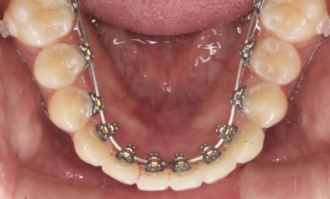 裏側矯正 虫歯になりにくい 横浜矯正歯科