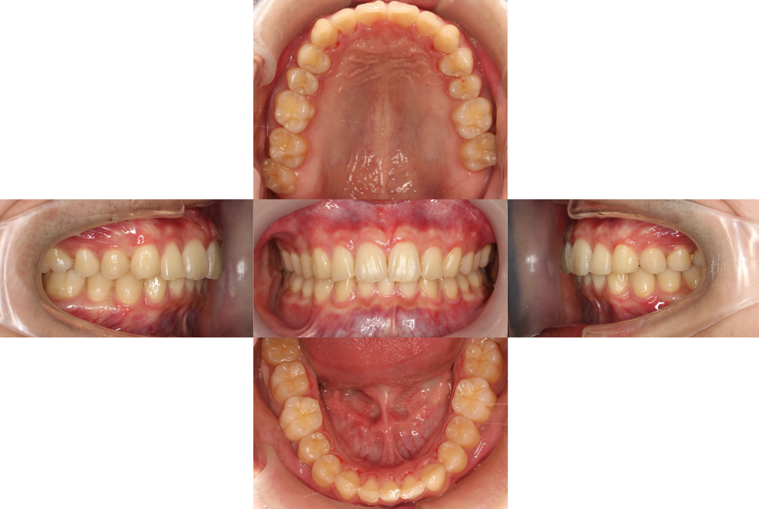 過蓋咬合・裏側矯正の症例