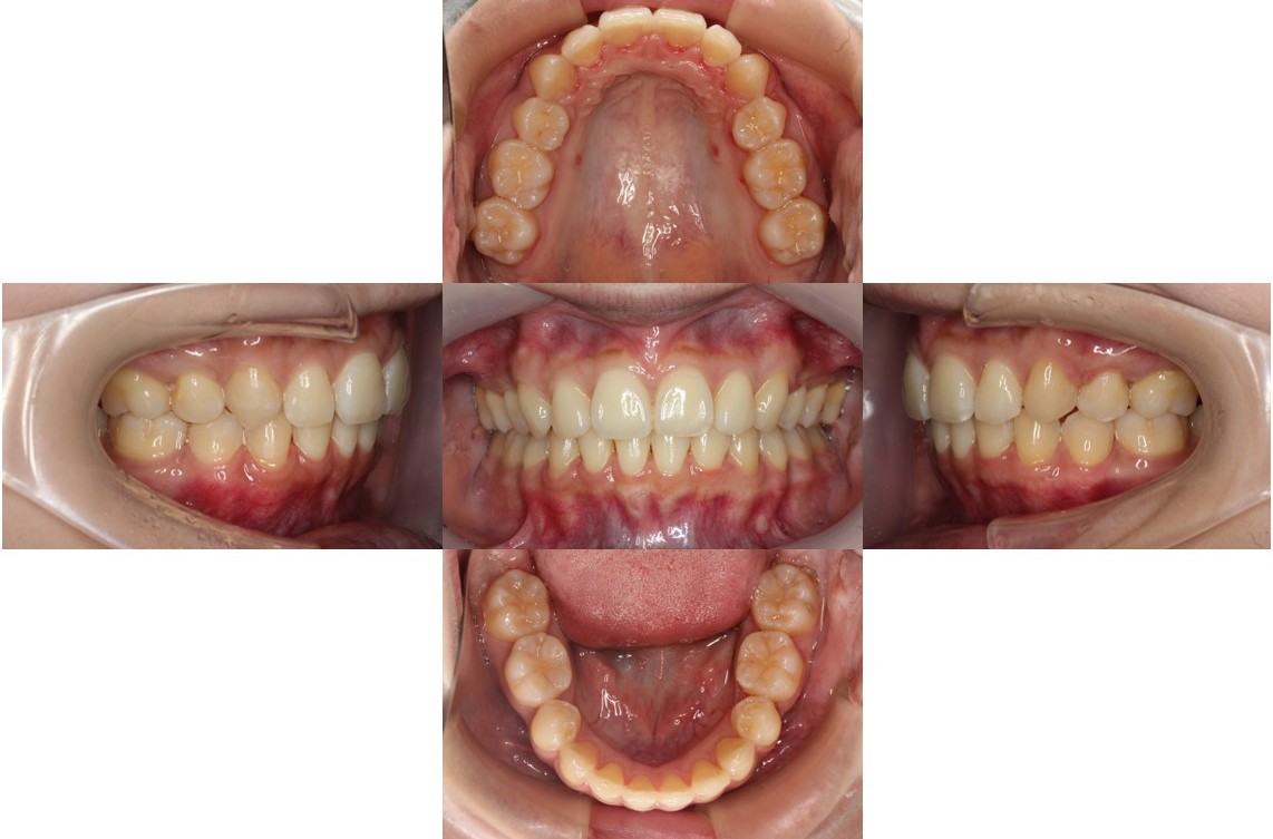 Eライン・ハーフ矯正