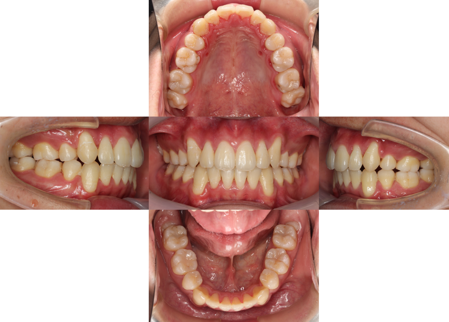 叢生・ハーフ矯正の症例