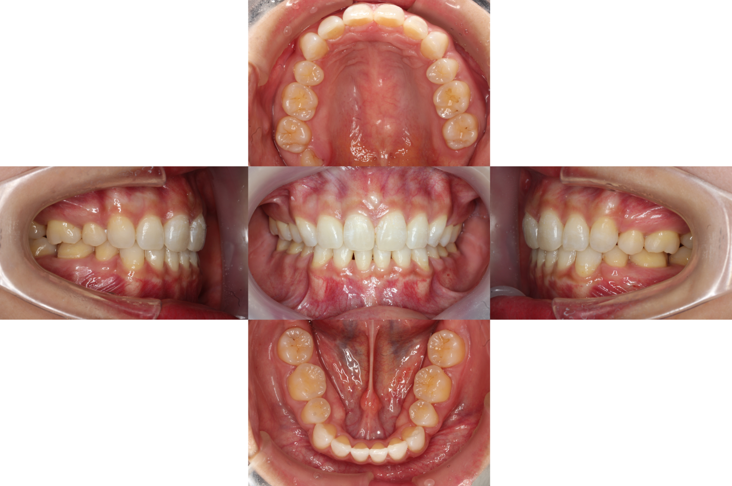 上顎前突・裏側矯正の症例