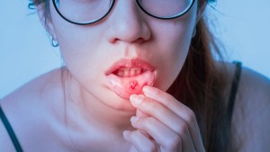 口内炎の原因3選