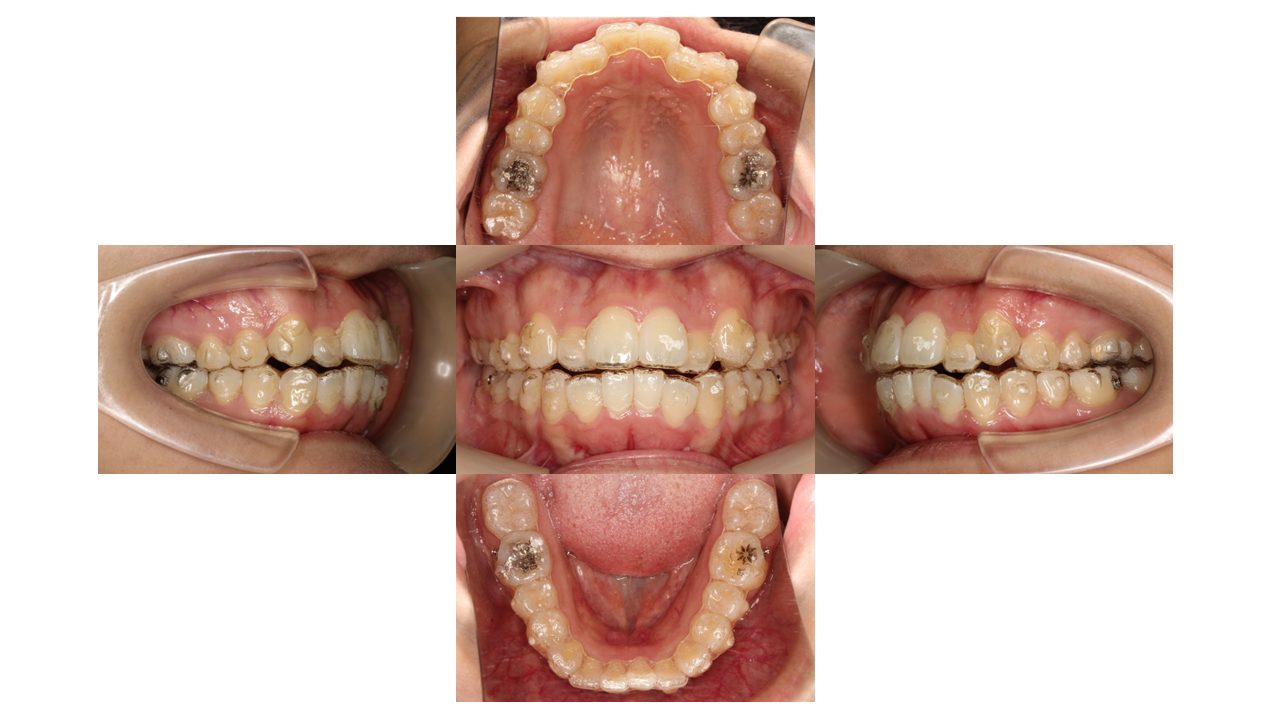 前歯の凸凹 八重歯 マウスピース矯正 インビザライン