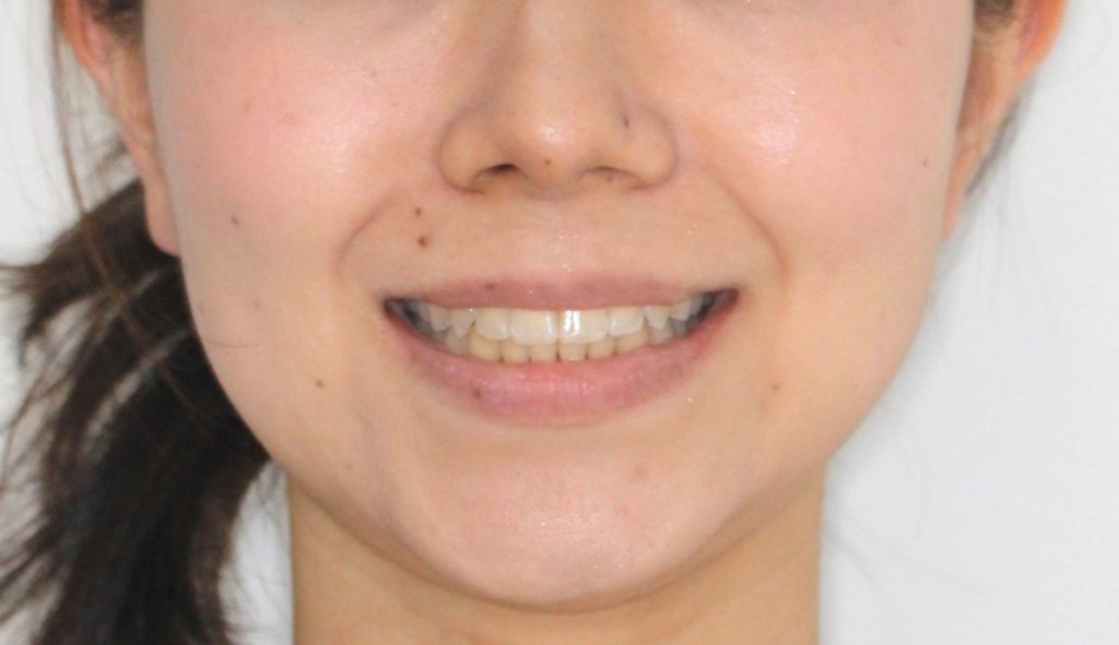 八重歯・ハーフ矯正の症例