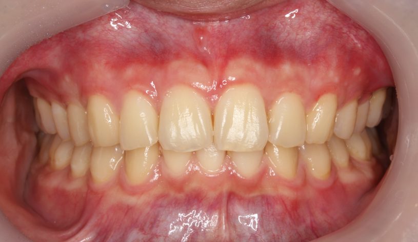 過蓋咬合・裏側矯正の症例