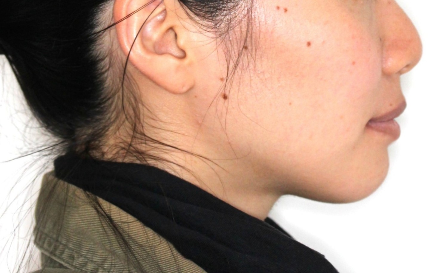 上顎前突・叢生の症例