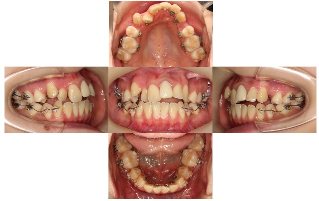 叢生・リンガル症例