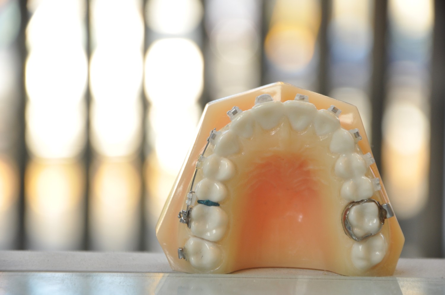 仮歯　矯正治療　差し歯
バンド