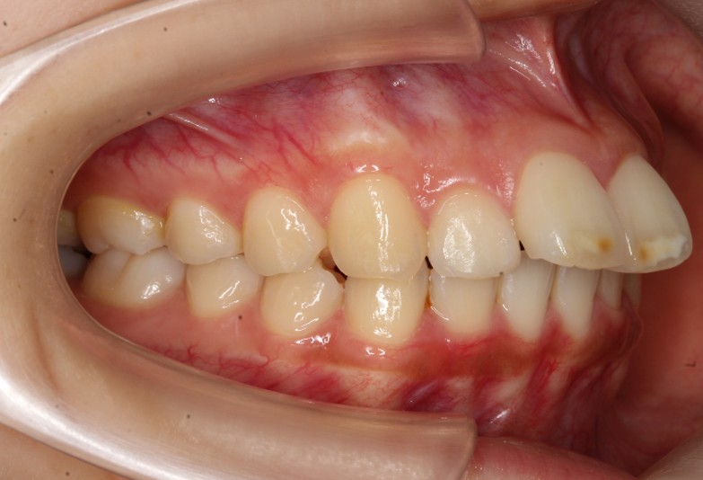 上顎前突・裏側矯正