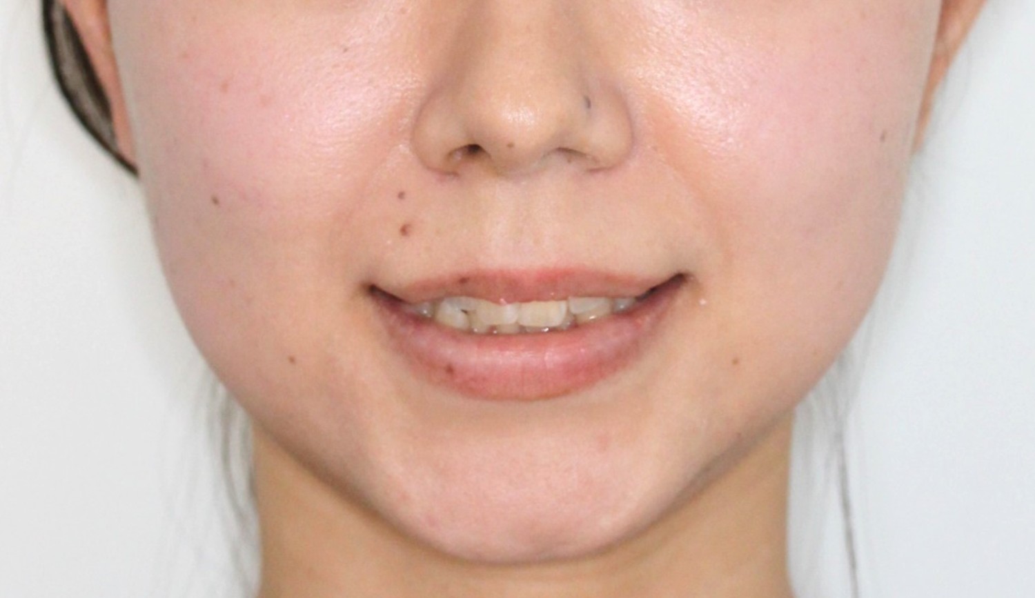 八重歯・ハーフ矯正の症例