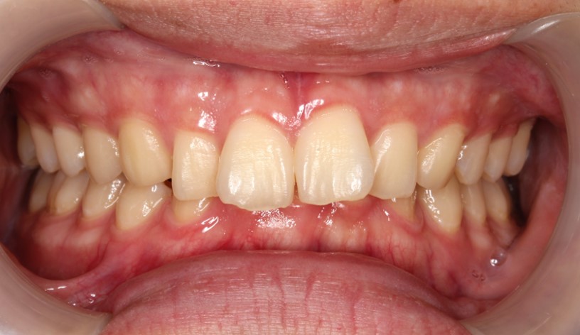 過蓋咬合・裏側矯正の症例