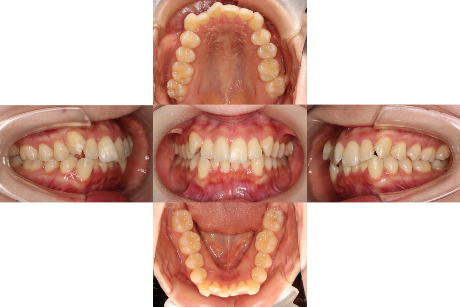 八重歯・リンガル矯正の症例