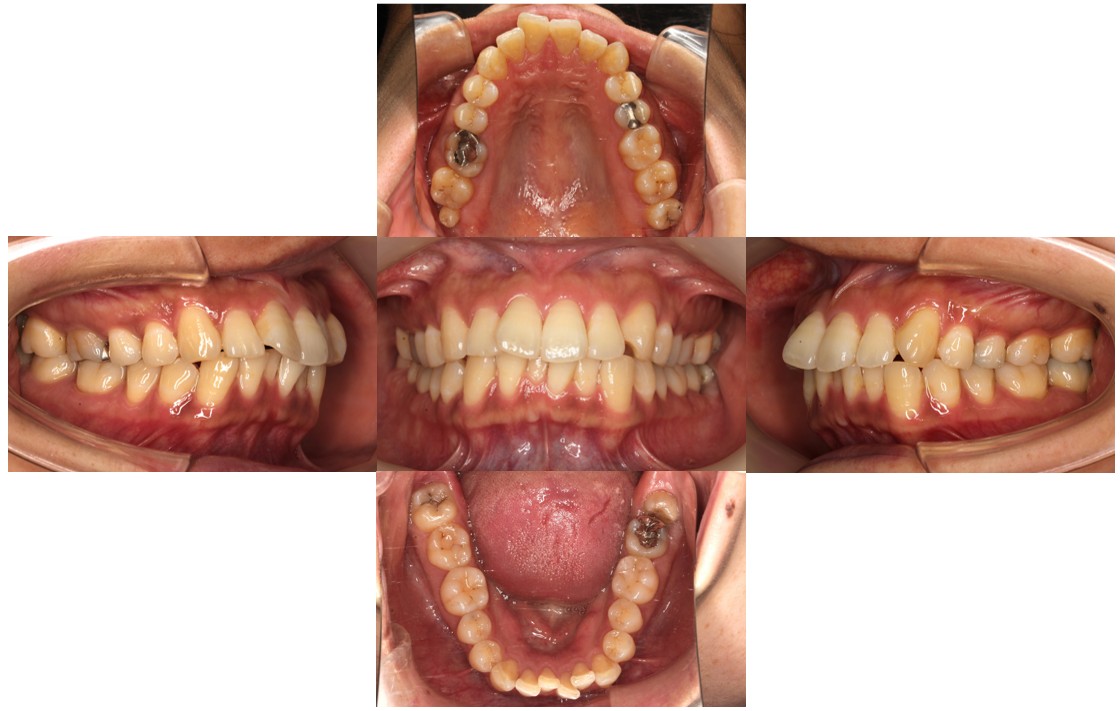 ガタガタ リンガル症例