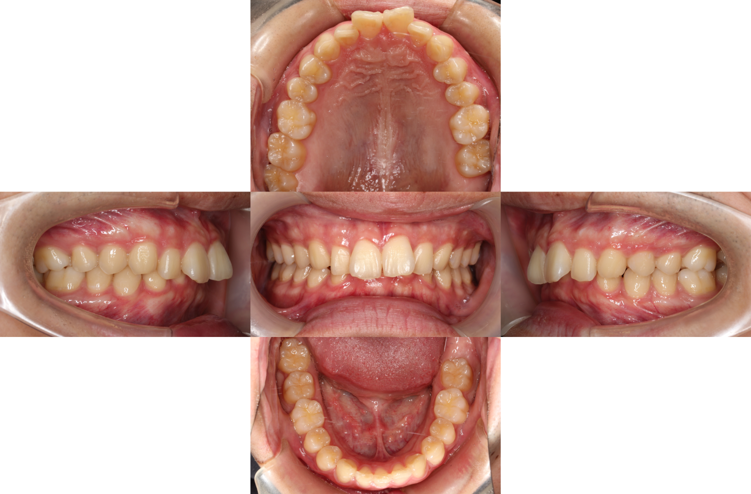 過蓋咬合・裏側矯正の症例