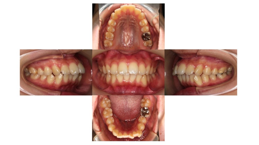 上の歯出ている、裏側矯正症例