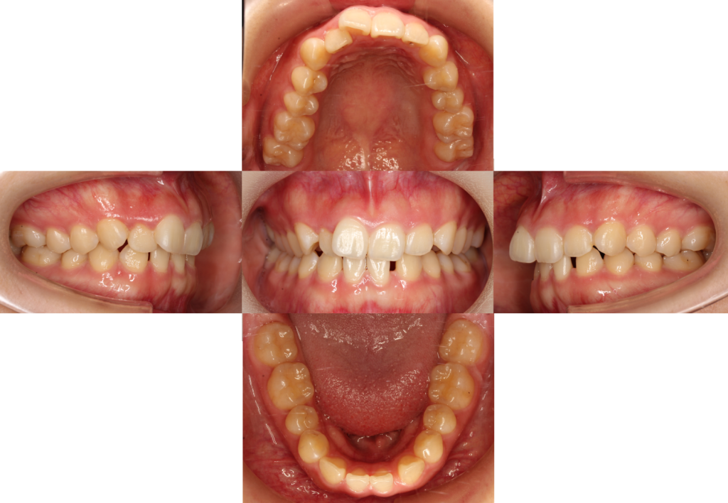 すきっ歯・裏側矯正の症例